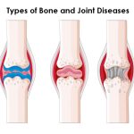 Types of Bone and Joint Diseases